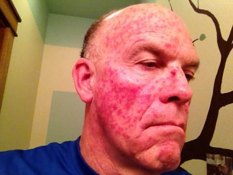 Orcutt had to endure the pain of these spots for a couple of weeks. It was worth it for smooth healthy skin. 